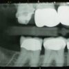 PTSD Triples Odds for Teeth Grinding, Study Finds