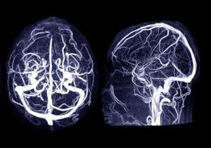 What Is a Cerebral Aneurysm? What Are the Signs?