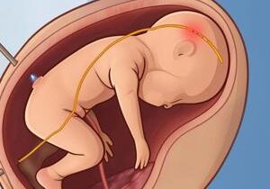 Tiny probe monitors unborn baby’s health inside womb during surgery